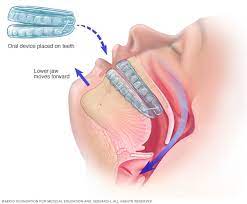 Snoring & Sleep Apnea | Sleep Apnea Treatment | Symptom of Sleep Apnea