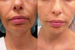 Morpheus8 Skin Tightening Treatment