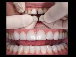 What Are Dental Veneers? | Full Set of Veneers Cost | Benefits of Veneers