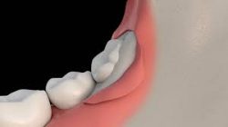 Managing the Cost of Wisdom Teeth Removal Houston