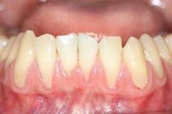 Periodontal Gum Disease Treatment | Signs of Gingivitis And Periodontitis