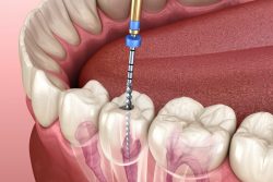 Root Canal treatment cost in Chennai