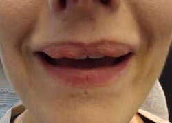 Lip Fillers Near Me