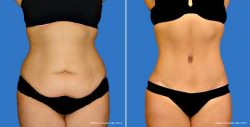 Best Tummy Tuck Surgeon Near Me