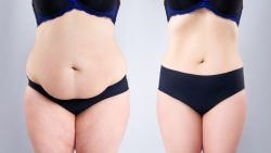 Best Tummy Tuck Surgeon in Marbella