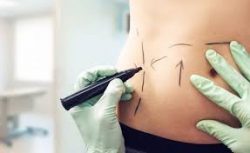 Best Tummy Tuck Surgeon Near Me