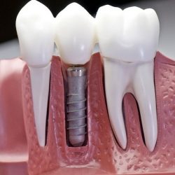 Affordable Dental Implant Near Me