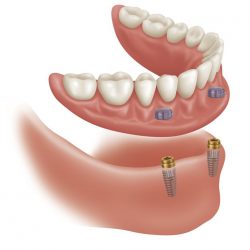 Affordable Partial Dentures Near Me