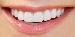 Dental Veneers Houston Tx