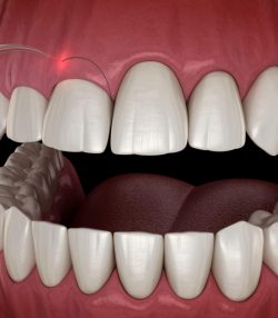  LANAP Surgery Houston