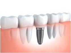 Affordable Dental Implants Near Me