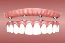 Different Types of Dental Implants