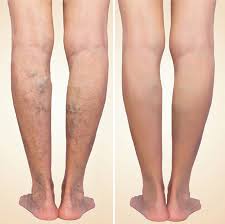 How Much Does Varicose Vein Treatment Cost?