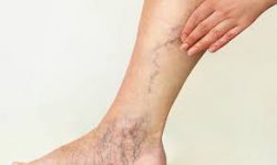 Vein Treatments Hamptons | Board Certified Vein Treatment Experts Hamptons