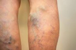 Laser Ablation – New York Vein Treatments