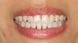 Minimal Prep Veneers in Sunny Isles, FL