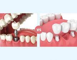 Minimal Prep Veneers in Aventura, FL