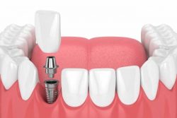 Emergency Dentist in Spring Branch, TX