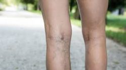 Radiofrequency Ablation (RFA) | Long Island Vein Treatment