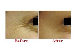 Best Botox Treatment in Delhi | Sculpt India