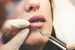 Dermal Filler Treatments London | Aesthetic Clinic Surrey