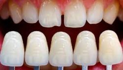 Types of Veneers to Transform Your Smile | Composite Veneers | Lumineers