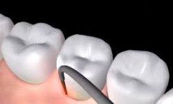 LANAP Laser Gum Disease Treatment | Advanced Laser Gum Surgery