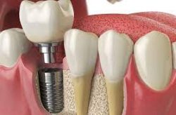 Dental Implants Near Sector 86 Gurgaon