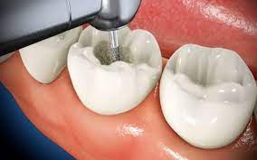 I Have A Root Canal — What Are My Options? – Houston Dentist | Best Dentist in Houston, TX