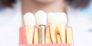 How to Find a Dental Implant Specialist – Dentist Houston TX