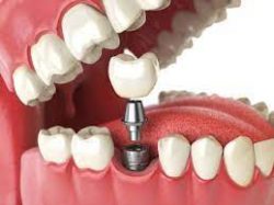 How much does a dental implant cost?