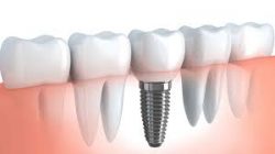 How much does a Tooth implant cost?