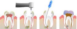 Root Canal Treatment Procedure