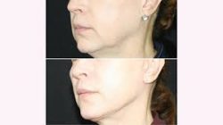 Benefits of Neck Liposuction