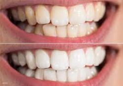 porcelain veneers teeth cost in Houston