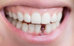 average cost of porcelain veneers