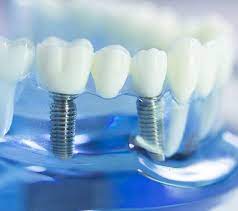 Affordable Dental Implants in Houston