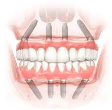 Invisalign Attachments | Invisalign Rubber Bands | Invisalign Buttons