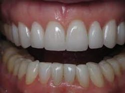 Dental Veneers Houston TX | Average Cost of Veneers