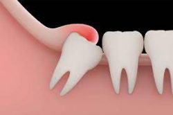 Wisdom Teeth Extraction | Wisdom Teeth Removal Aftercare | Wisdom Teeth Symptoms