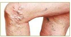 What Doctor Treats Varicose Veins?