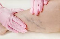 Dr. Zalekha Shair | Vein Doctor in Long Island, NY