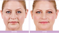 buy dermal fillers online usa