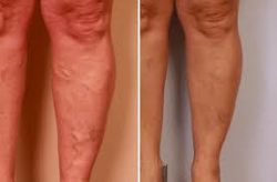 What is a vein center?