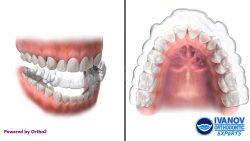 Orthodontic Emergencies | Emergency Orthodontist Appointment Near Me