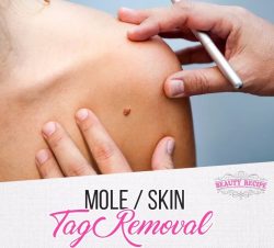 Skin Tag Removal Service In Singapore 