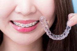 Are Invisible Braces The Same as Invisalign | Invisible braces and Invisalign