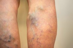 What Kind of Specialist Treats Varicose Veins? | Varicose Vein Treatments in NJ