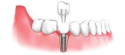 Affordable Dental Implants Near Me