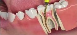 Root Canal Procedure & Treatment Specialist | Root Canal Dentist